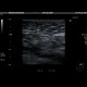 Chronic lymph node: US - Ultrasound
